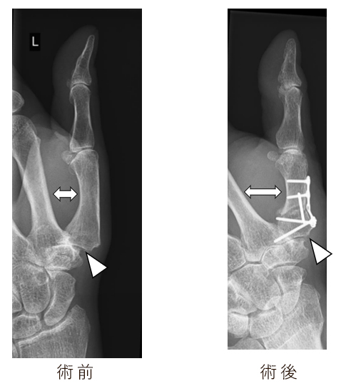 中手骨楔状骨切り術の手術前後