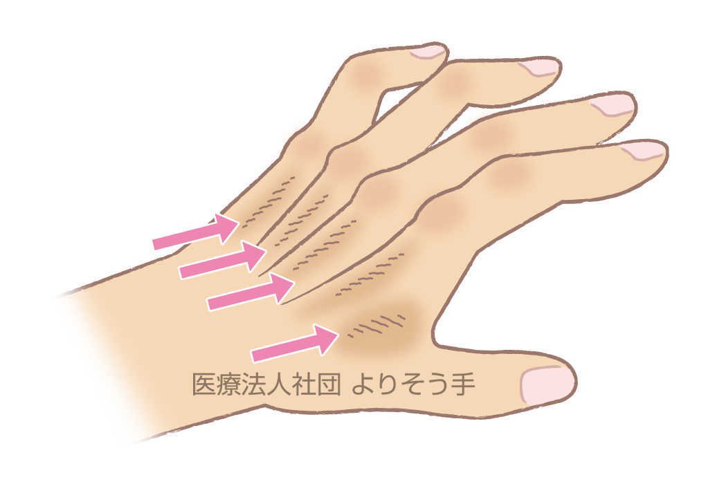 小指と薬指にしびれが出る肘部管症候群