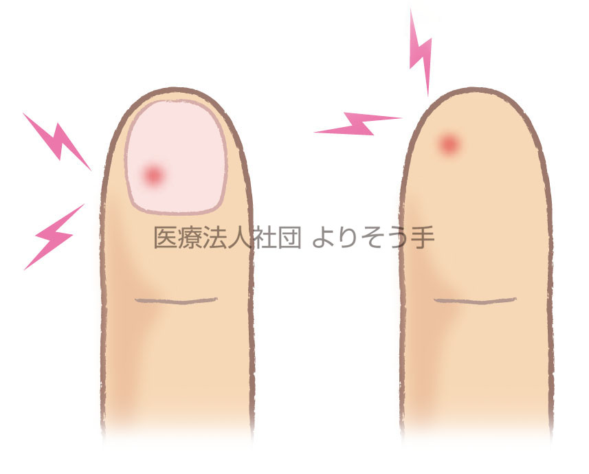 指尖部の激痛 グロームス腫瘍