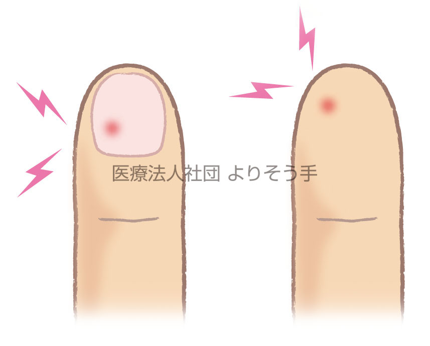 指尖部の激痛 グロムス腫瘍
