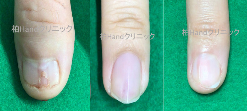爪下に腫瘍があると、爪にも変化が出てきます。特に縦に盛り上がりや、爪割れが出てきます。