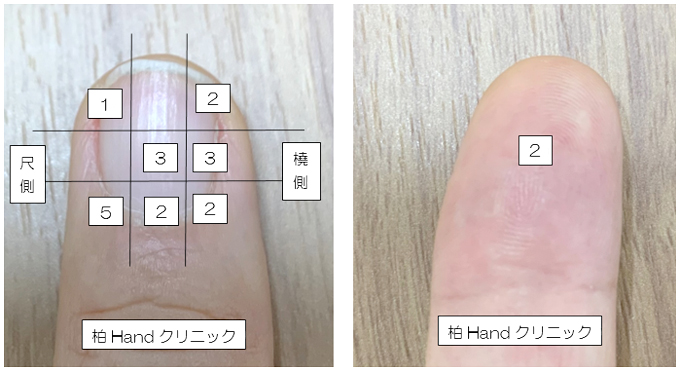 グロームス腫瘍の発生場所