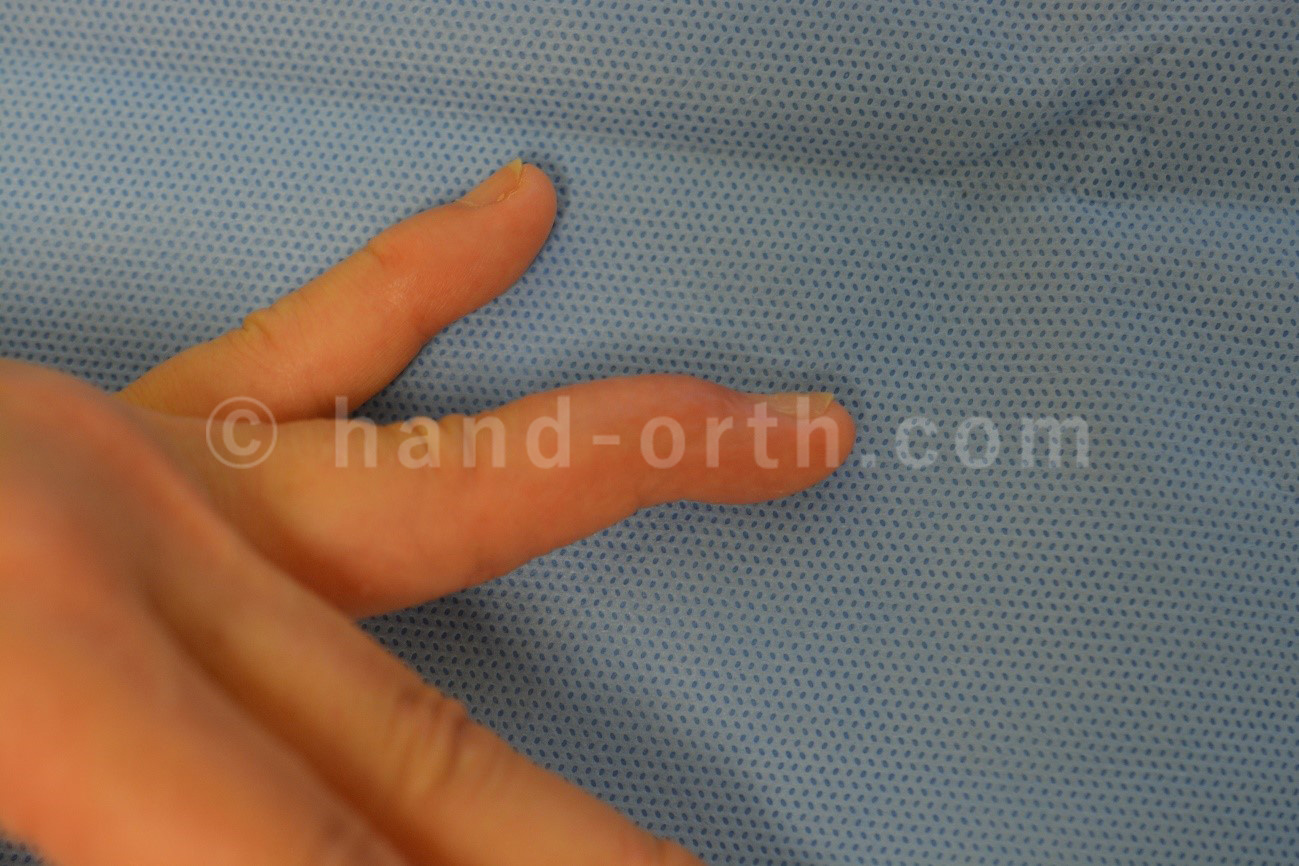 腱性槌指（マレット指）保存的治療