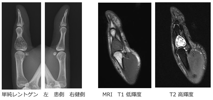 内軟骨腫レントゲン