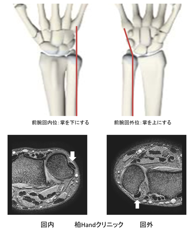 尺側手根伸筋腱炎、周囲炎