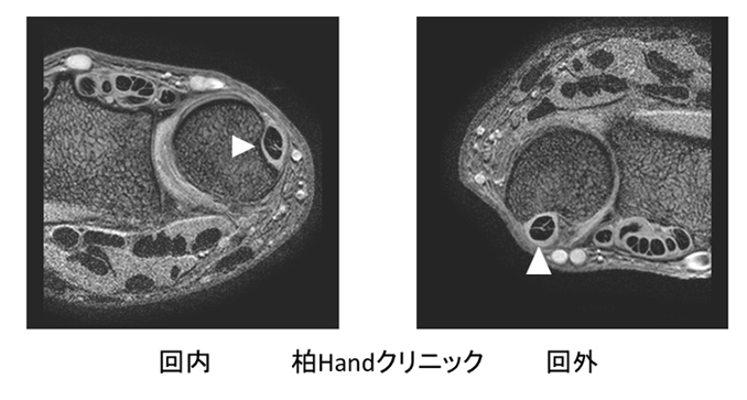 尺側手根伸筋腱炎、周囲炎