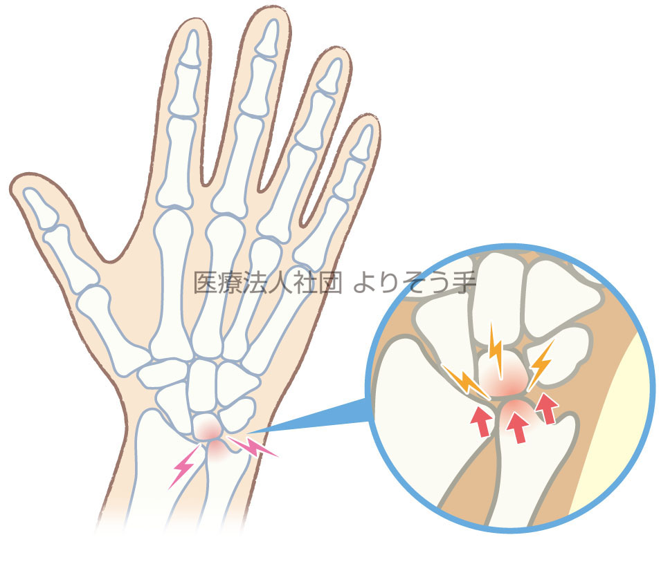 軟骨を痛めたり、関節が炎症を起こす尺骨突き上げ症候群