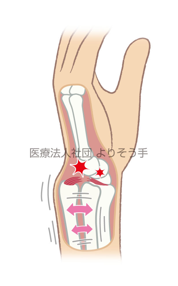 尺側(小指側)に痛みが出るTFCC損傷