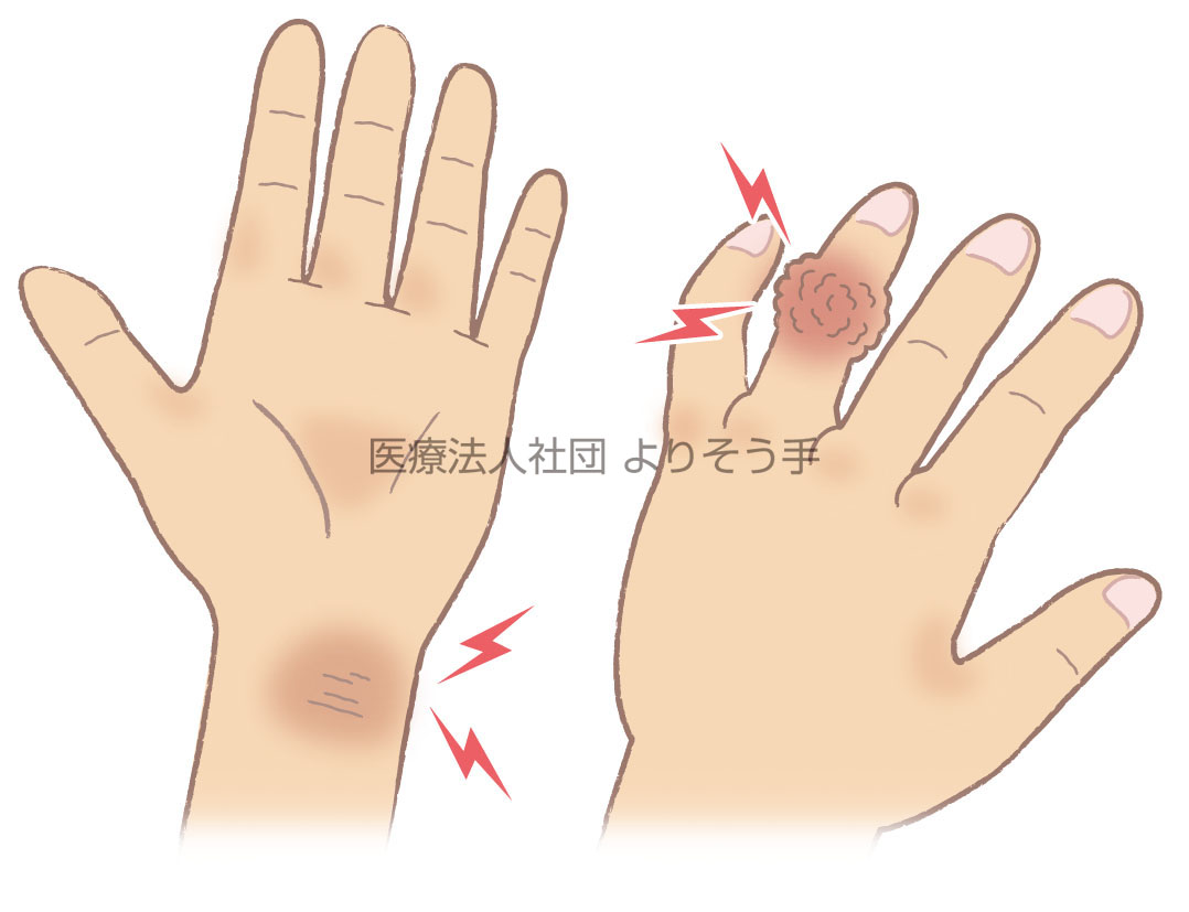 指、手の甲、手の関節が腫れる痛風性関節炎
