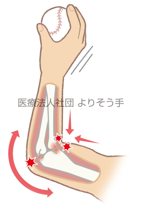 ひじに痛みが出る野球肘