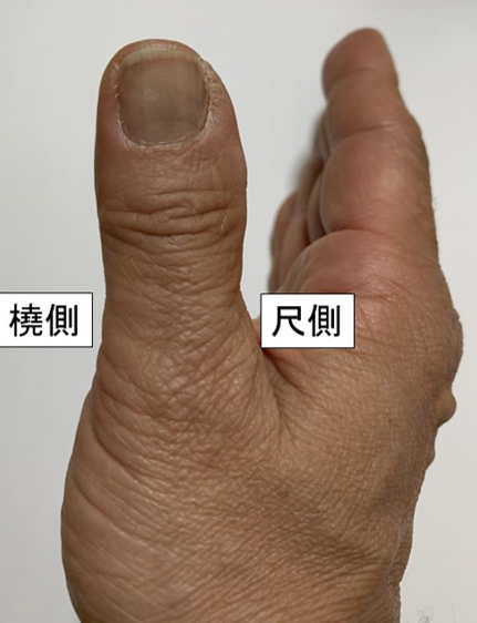 母指のMP関節側副靭帯　症状
