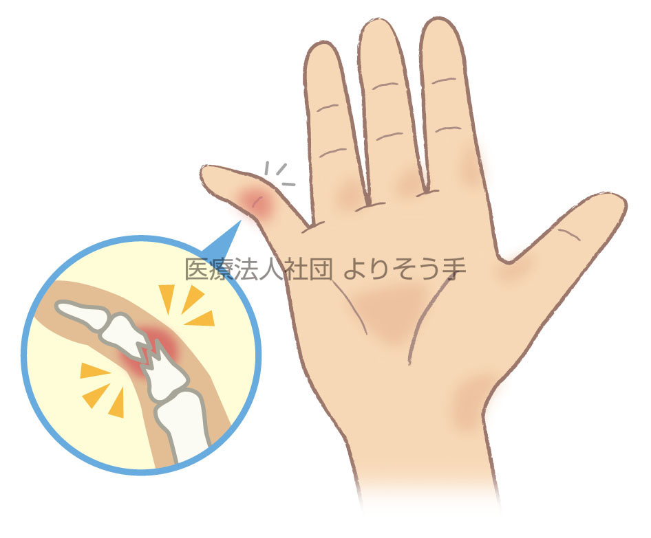 局所の腫れ、出血、指の変形を伴う手指骨折