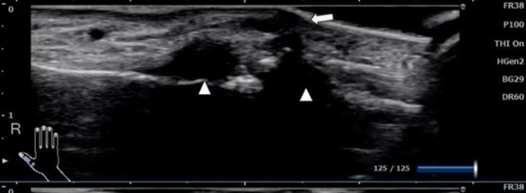 手関節部分のガングリオンの超音波画像