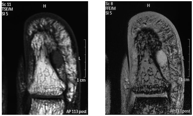 グロムス腫瘍エコー画像