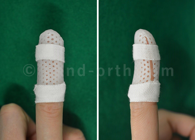 骨性槌指(マレット指)保存的治療