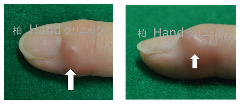 ミューカス嚢胞 ミューカスシスト 手の治療専門サイト 整形外科医 田中利和 公式 手 指の痛み 関節痛 曲がらない 伸ばせない ひっかかる