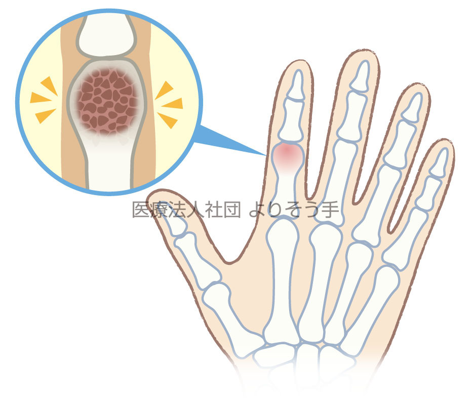 軟骨組織が異常に増えてしまう内軟骨腫