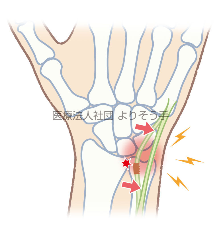 尺側の腱が脱臼する尺側手根伸筋腱脱臼