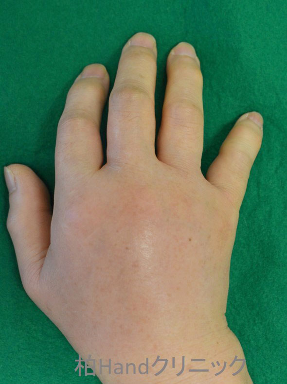 痛風性関節炎 手の治療専門サイト 整形外科医 田中利和 公式 手 指の痛み 関節痛 曲がらない 伸ばせない ひっかかる
